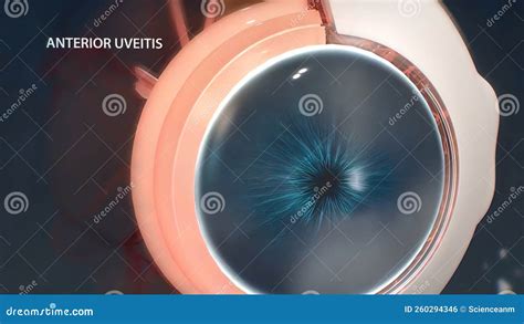 Uveitis is the Inflammation of Part or All of the Uvea in the Eye. it ...