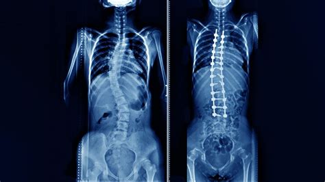 Scoliosis X Ray Before And After