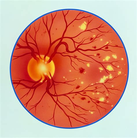 Artwork Of Diabetic Retinopathy Ophthalmoscope View Photograph by John ...