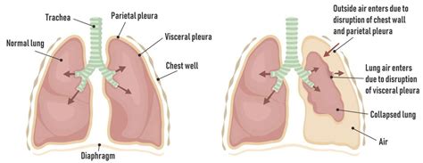 Chest Tube Pneumothorax