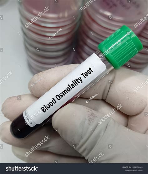 Blood Sample Serum Osmolality Test Helps Stock Photo 2224600805 ...