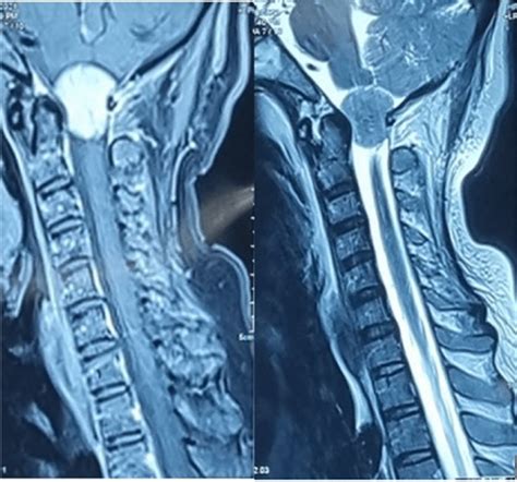 Brain MRI, Sagittal view revealed a mass in the foramen magnum ...