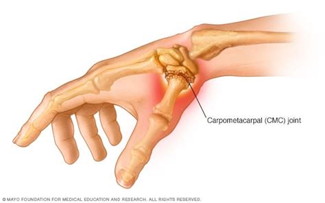 Thumb arthritis - Mayo Clinic