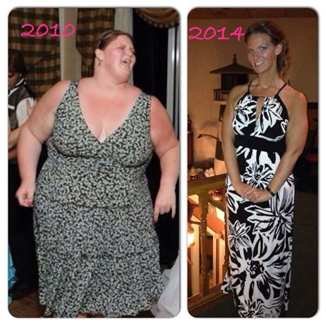 Michelle Before And After Lap Band Surgery | Obesity Coverage