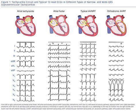 Figure 1: Tachycardia Circuit and Typical 12-lead ECGs in Different ...