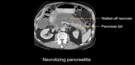 Abdominal CT: necrotizing pancreatitis • LITFL • Radiology Library