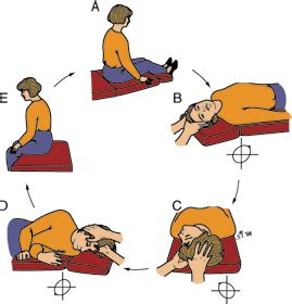 Epley-CRP maneuver for BPPV