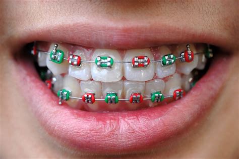 Metal Braces VS Clear Braces - Bali Implant Aesthetic (BIA) Dental Center