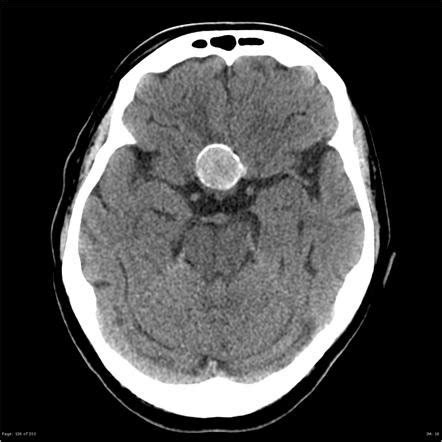 Do brain aneurysms show up in a CT scan? - Quora