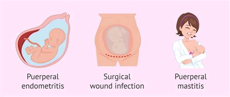 What is puerperal fever? - Symptoms, causes and treatment