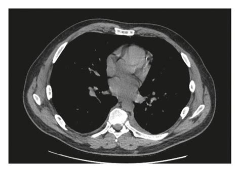 Repeat CT demonstrating resolution of hydropneumothoraces in the (a ...