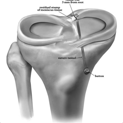 —anatomy of posterior roots. Mte: medial tibial eminence; lte: lateral ...