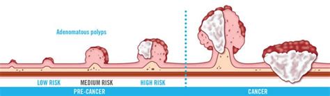 Types Of Colon Polyps Chart