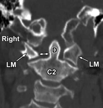 Atlantoaxial Joint Subluxation