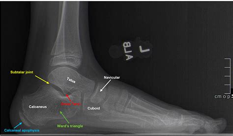 A Review of Pediatric Heel Pain | Cureus