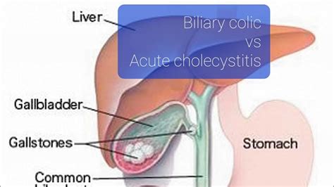 Biliary colic vs acute cholecystitis ! - YouTube