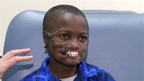 Chimp attack survivor to get rare facial reconstructive surgery after ...