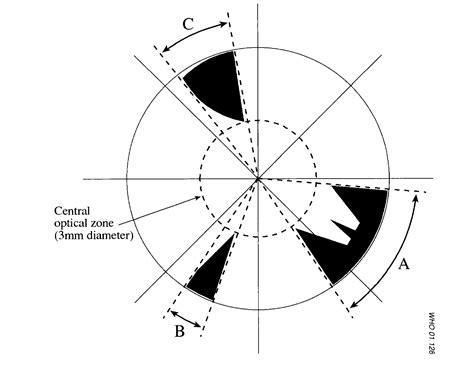 How to diagnose and grade cataracts - EyeGuru