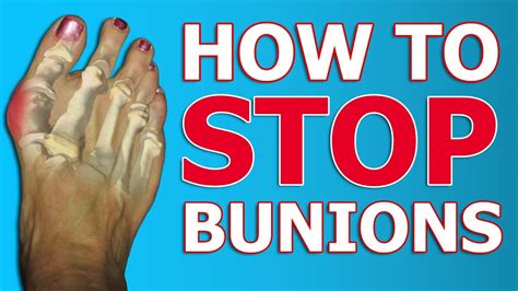 3 Tips To CORRECT Bunions | Physical Therapy Exercises And Taping ...