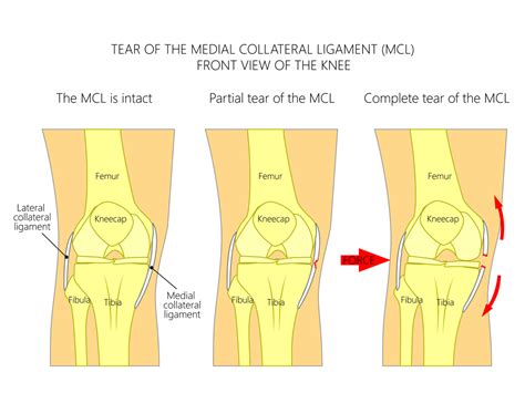 MCL | The Stone Clinic