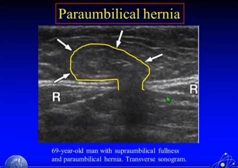 Ultrasound Imaging of Hernia Parts 1 + 2 of 4 – A YouTube Video | Tom ...