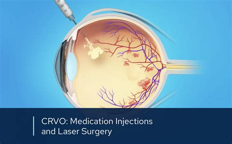 Panretinal Photocoagulation | Retinal Consultants Medical Group