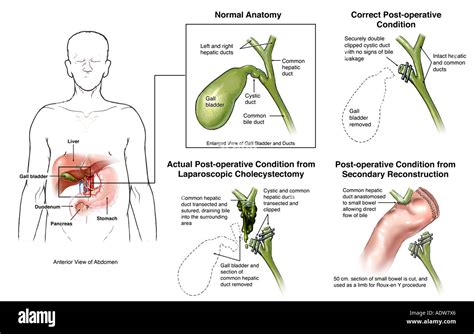 Gall Badder Removal Post Op Instructions