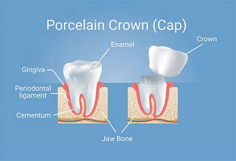 Porcelain Crowns (caps) | San Luis Obispo Dentist Friendly Smiles Dental