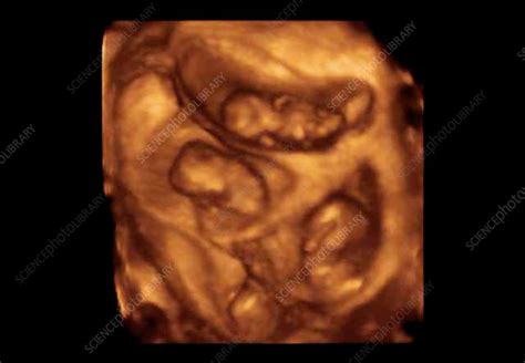 Quadruplets, 4-D ultrasound scan - Stock Image - C001/5694 - Science ...