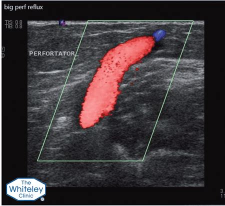 Venous perforator surgery reduces recurrent varicose veins - The ...