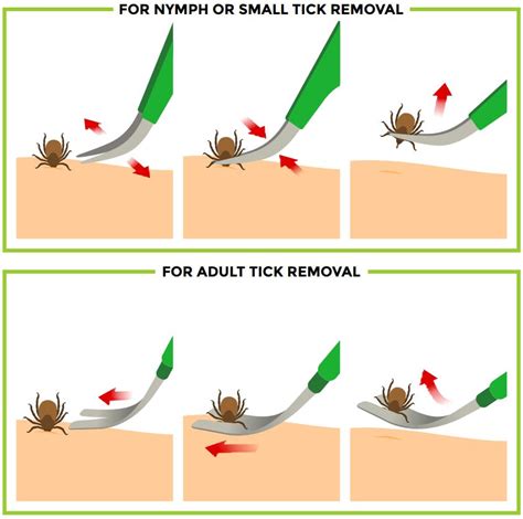 TickCheck.com - How to safely remove a tick