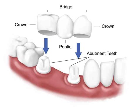 Dental Bridges | Elite Dental Group