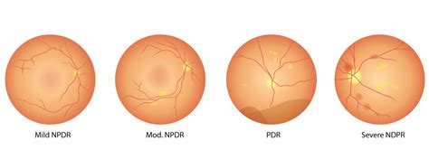 The 4 Stages of Diabetic Retinopathy | Atkinson Eye Care | Diabetic ...