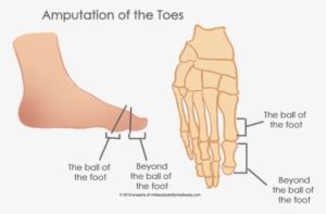 The Amputation Of The Toes 6 - Hallux Amputation Transparent PNG ...