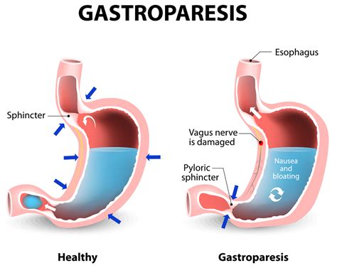 Gastroparesis - Causes, Symptoms, Diet, Medications & Treatment