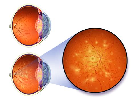 Nonproliferative diabetic retinopathy | Eye Disorders and Diseases ...