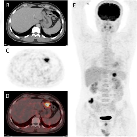 A 71-year-old male patient with mucinous adenocarcinoma in the ...