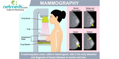 Diagnostic Mammogram Procedure