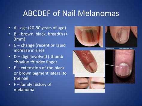 Can Melanoma in a Nail Be Green? — Scary Symptoms