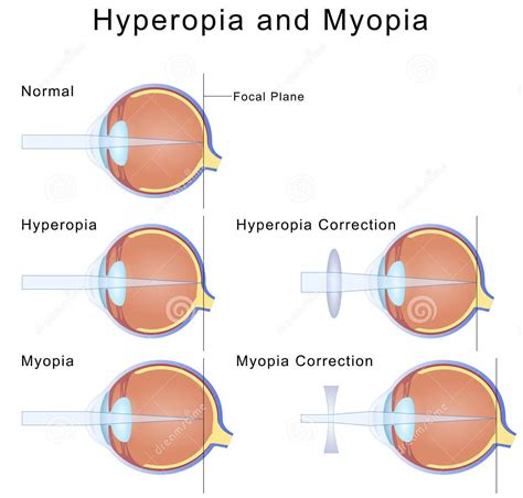 Myopia & Hyperopia | Vision Care(I) Pvt Ltd