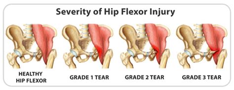 Hip Flexor Strain: Signs, Causes, Treatment and Recovery | IYTmed.com