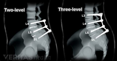 Fusion Definition | Back Pain and Neck Pain Medical Glossary