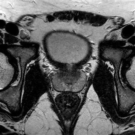 Prostate Gland Anatomy Mri