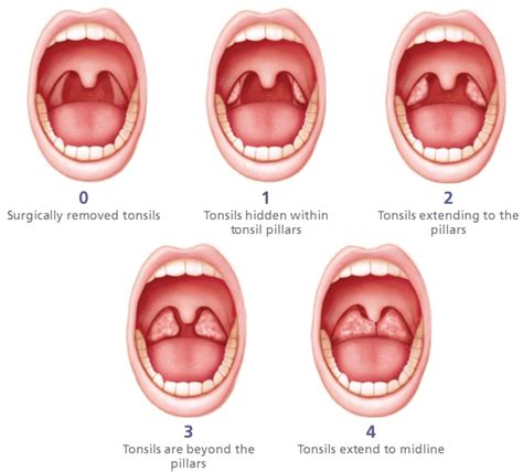 Tonsils Before And After