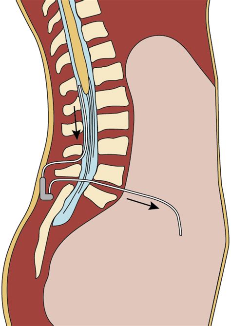 LP SHUNT - Longhorn Brain and Spine