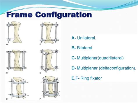 Principles of external fixators - презентация онлайн