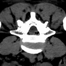 A: MRI T2W axial plane showed a large synovial cyst on the left ...