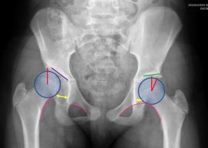 Hip Dysplasia-Adolescent - Description