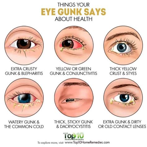 Things Your Eye Gunk Says about Health | Top 10 Home Remedies | Eye ...