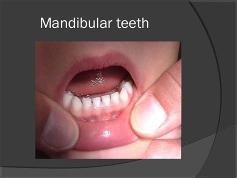 Morphology of deciduous dentition